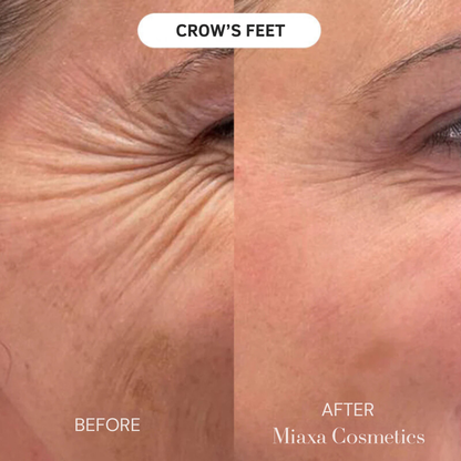 Miaxa™ Micro-Infusion Kit – Anti-Ageing Solution