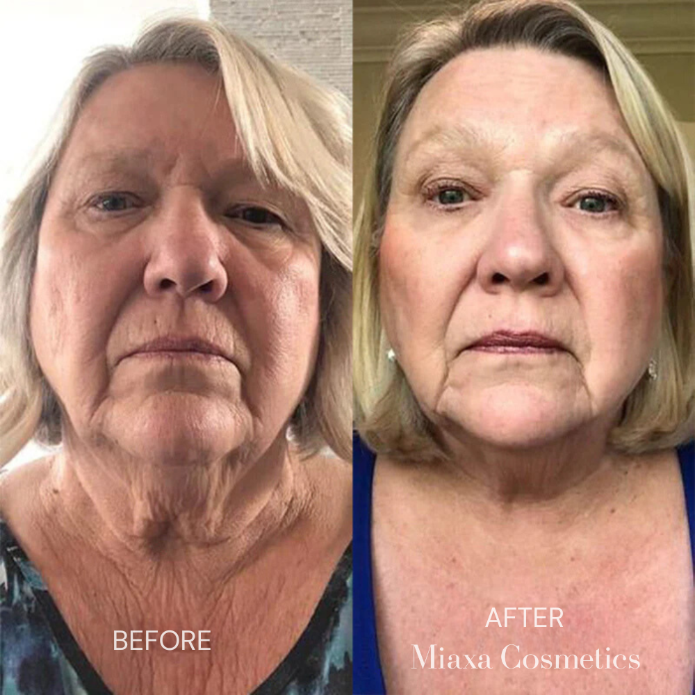 Miaxa™ Micro-Infusion Kit – Anti-Ageing Solution